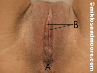 After (A) Labia majora, posterior convergence (B) Labia minora reduction