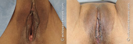Labia Minora Reduction - Before and After