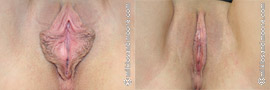 Labia Minora Reduction - Before and After
