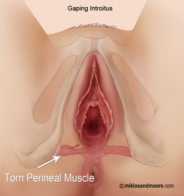 Gaping introitus enlarged 