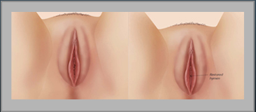 Hymen Restoration Before and After Gallery
