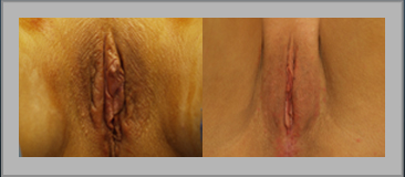 Labia Majora Augmentation Before and After Gallery