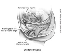 Vaginal Agenesis