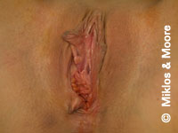 Before Botched Vaginal Surgery Revision