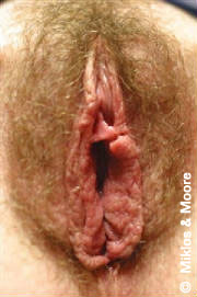 Before Botched Vaginal Surgery Revision