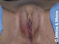 After Labia Majora Augmentation