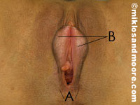 Before (A) Labia majora posterior divergence