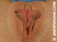 Before Labia Minora Reduction