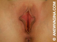 Before Labia Minora Reduction