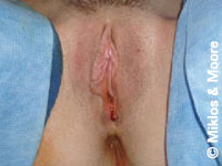 Before Labia Minora Reduction