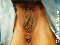 Before Labia Minora Reduction