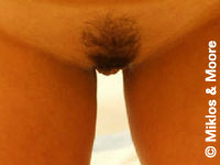 After Labia Minora Reduction