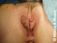 Before Labia Minora Reduction
