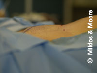 After Mons Pubis Reduction