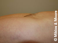 After Mons Pubis Reduction