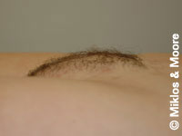 Before Mons Pubis Reduction