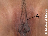Before Redundant Prepuce Removal Surgery