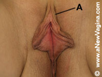 Before Redundant Prepuce Removal Surgery