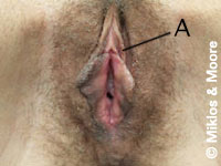 Before Redundant Prepuce Removal Surgery