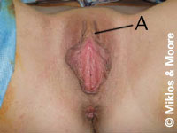 Before Redundant Prepuce Removal Surgery