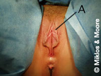 Before Redundant Prepuce Removal Surgery