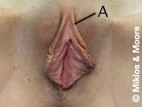 Before Redundant Prepuce Removal Surgery