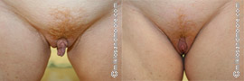 Clitoral Hood Lift - Before and After