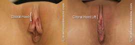 Clitoral Hood Lift - Before and After