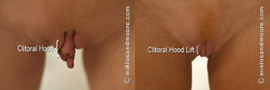 Clitoral Hood Lift - Before and After