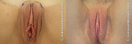 Clitoral Hood Lift - Before and After