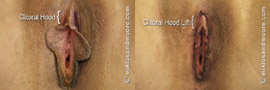 Clitoral Hood Lift - Before and After