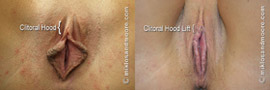 Clitoral Hood Lift - Before and After