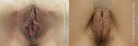 Labia Majora Augmentation Surgery Before  and After Photos