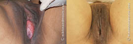 Labia Majora Reduction Before and After