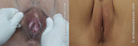 Labia Majora Reduction Before and After