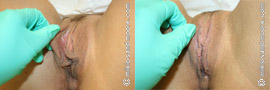 Labia Majora Reduction Before and After