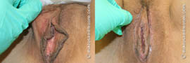Labia Majora Reduction Before and After
