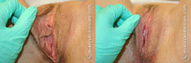 Labia Majora Reduction Before and After