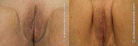 Labia Majora Reduction Before and After