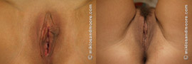 Labia Minora Reduction - Before and After