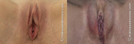 Labia Minora Reduction - Before and After