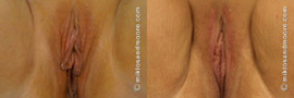Labia Minora Reduction - Before and After