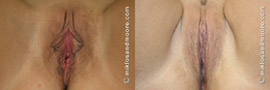 Labia Minora Reduction - Before and After