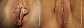 Labia Minora Reduction - Before and After