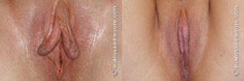 Labia Minora Reduction - Before and After