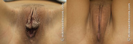 Labia Minora Reduction - Before and After