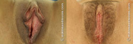 Labia Minora Reduction - Before and After