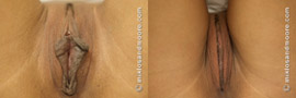 Labia Minora Reduction - Before and After