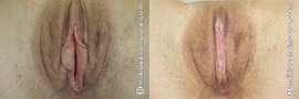 Vaginal Rejuvenation Before and After Gallery