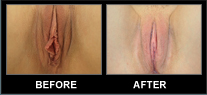 Clitoral Hoodectomy Before and After